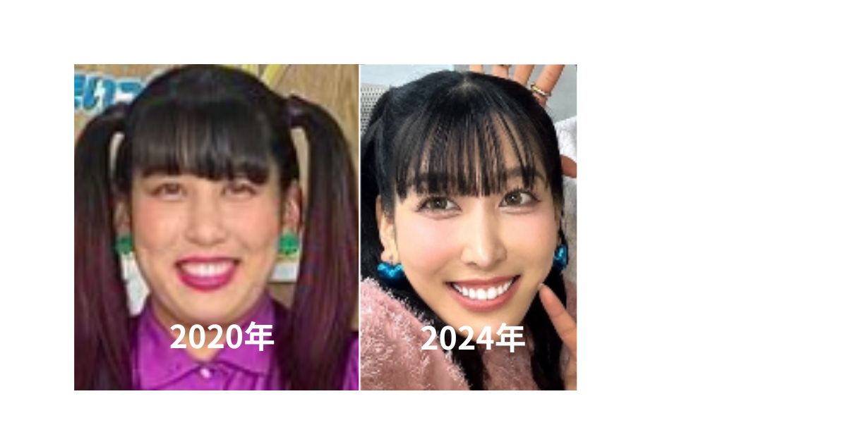 【画像比較】ゆめっちの前の顔と今の顔！美容整形の内容を調査！ | trendx